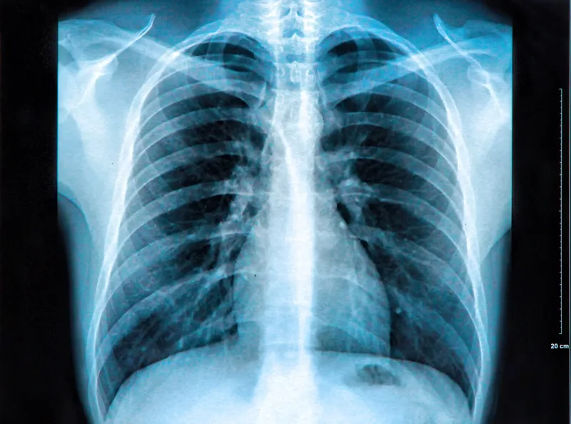 X-Ray
